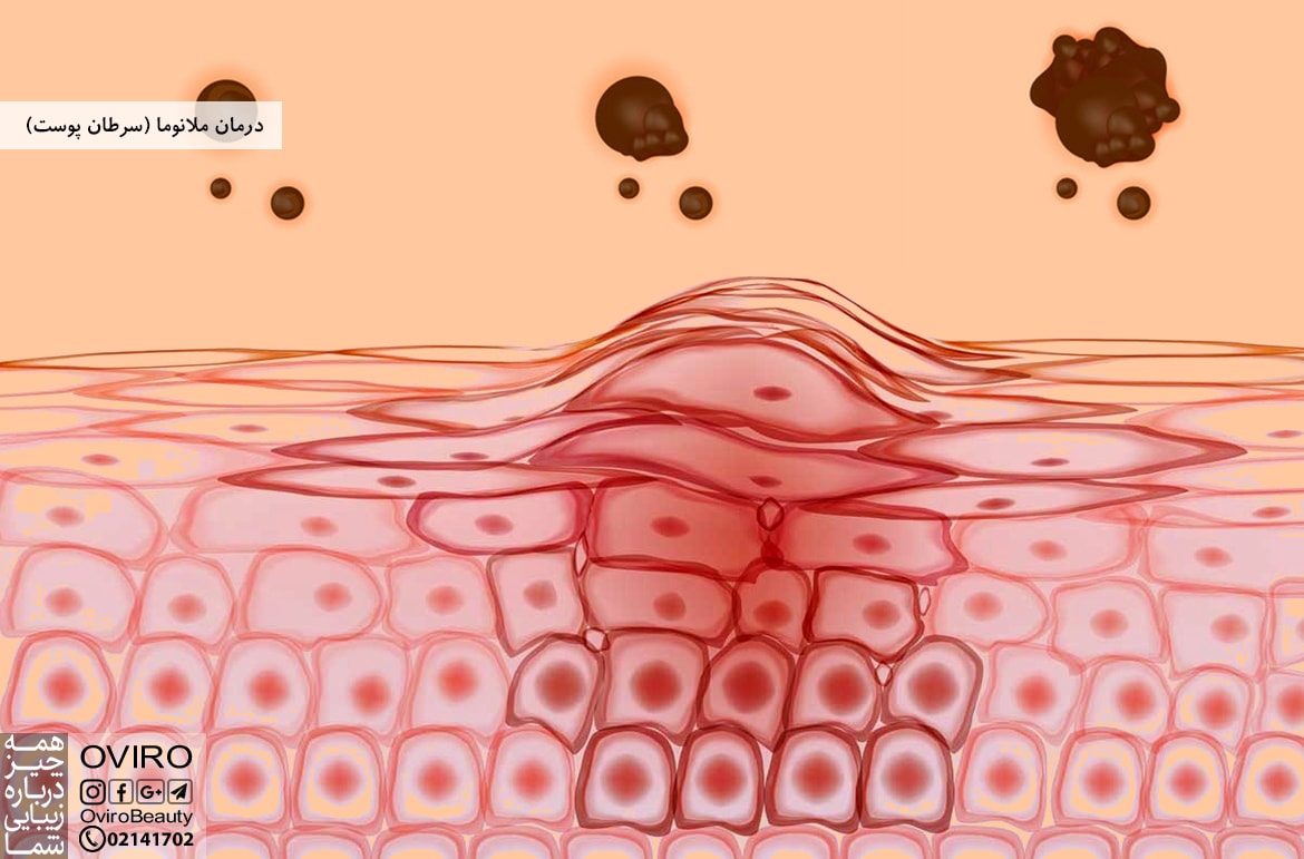 درمان ملانوما (سرطان پوست)