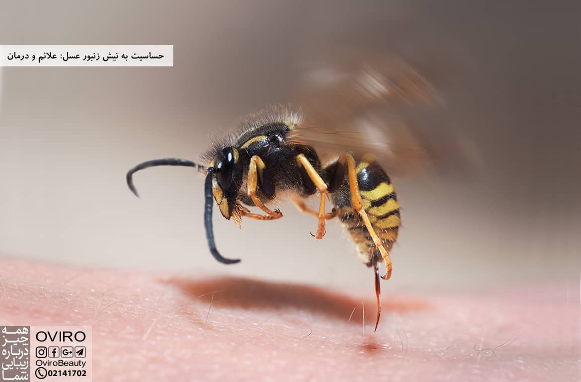 حساسیت به نیش زنبور عسل: علائم و درمان