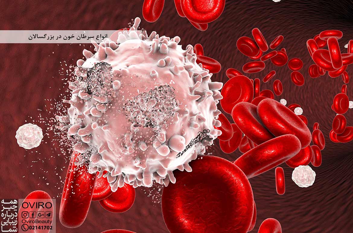 انواع سرطان خون در بزرگسالان : علائم و درمان | لوسمی حاد و مزمن