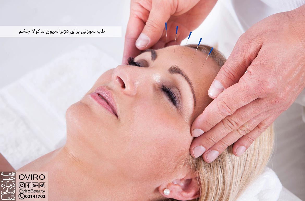 طب سوزنی برای دژنراسیون ماکولا چشم : اثرات - خطرات و عوارض